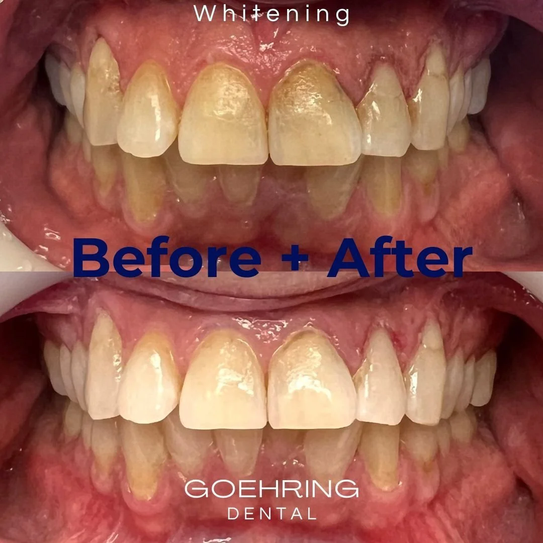 Professional Teeth Whitening Promotion