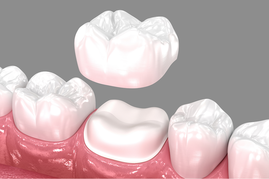 CEREC same-day crowns at Goehring Dental Group, Implants. Cosmetic. General Dentistry