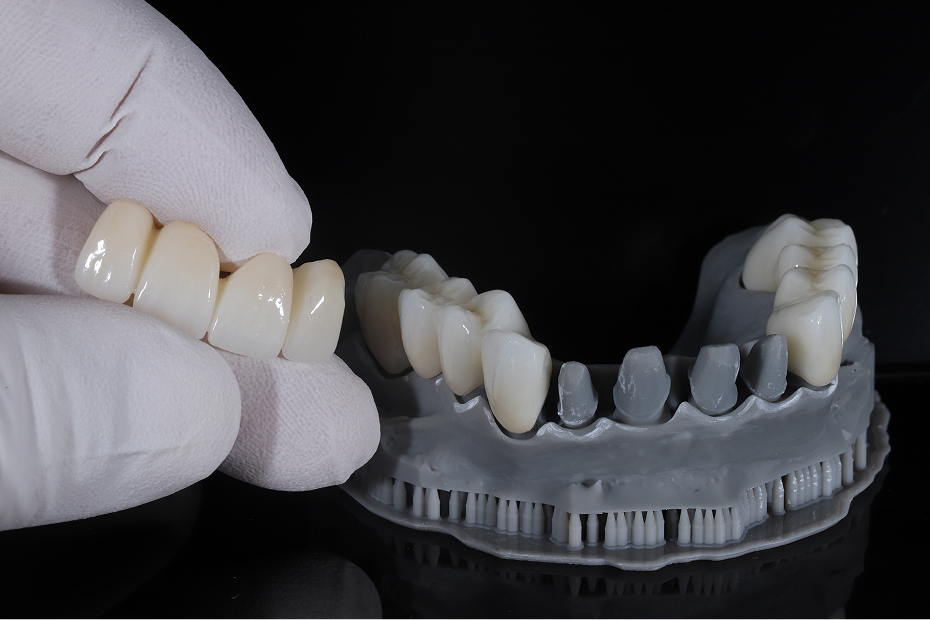 Dental crowns and bridges at Goehring Dental Group, Implants. Cosmetic. General Dentistry