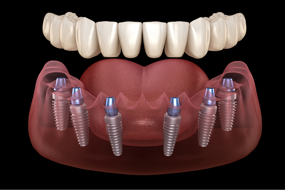 Dental implants at Goehring Dental Group, Implants. Cosmetic. General Dentistry