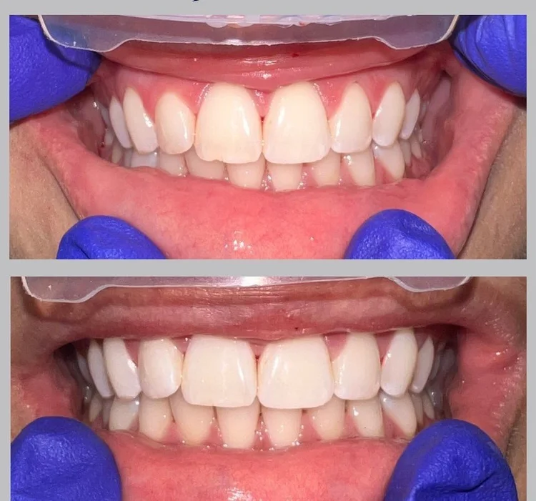 Teeth Whitening &mdash; Goehring Dental Group, Implants. Cosmetic. General Dentistry