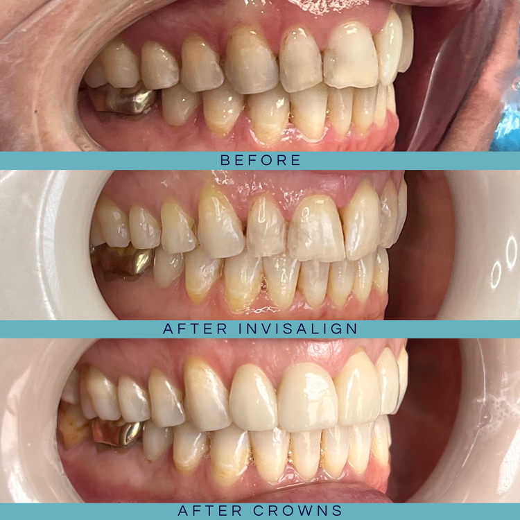 Invisalign / Orthodontics &mdash; Goehring Dental Group, Implants. Cosmetic. General Dentistry