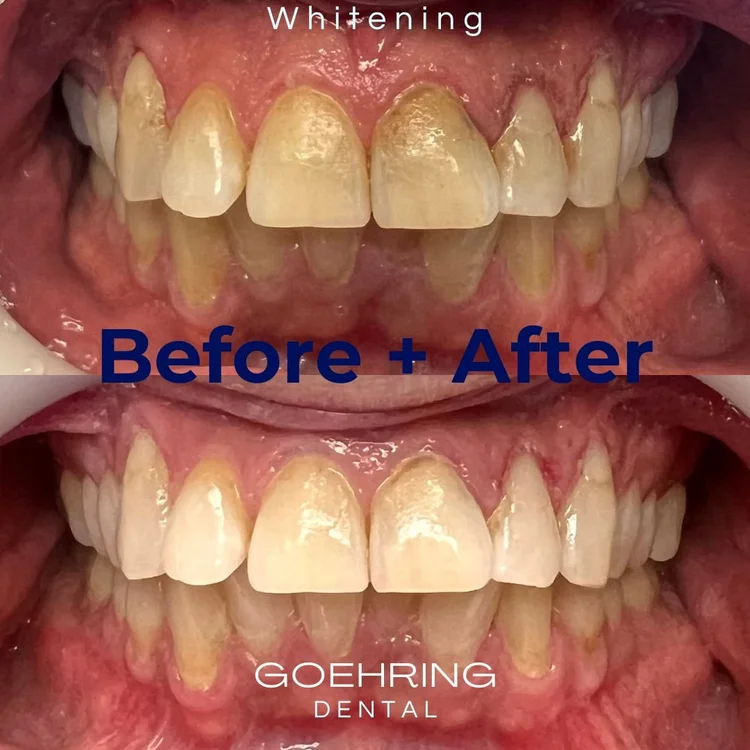 Teeth Whitening &mdash; Goehring Dental Group, Implants. Cosmetic. General Dentistry