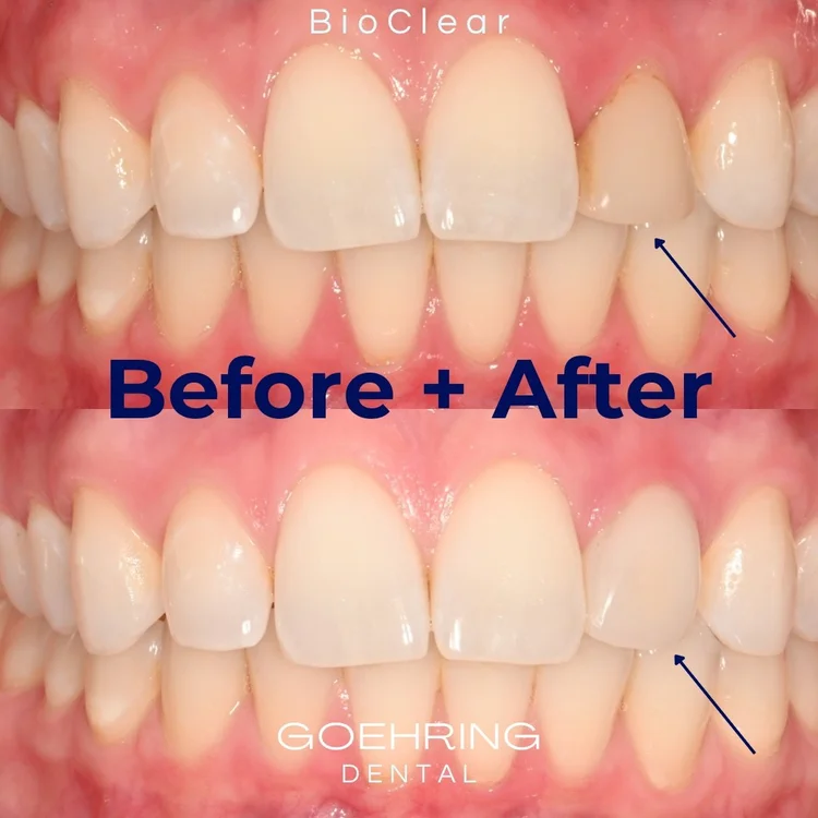 Porcelain Veneers &mdash; Goehring Dental Group, Implants. Cosmetic. General Dentistry