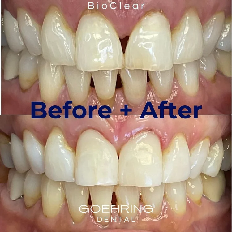 Porcelain Veneers &mdash; Goehring Dental Group, Implants. Cosmetic. General Dentistry