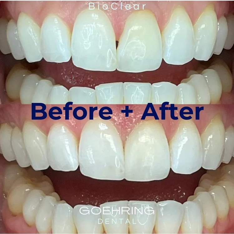Porcelain Veneers &mdash; Goehring Dental Group, Implants. Cosmetic. General Dentistry