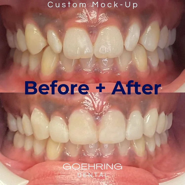 Porcelain Veneers &mdash; Goehring Dental Group, Implants. Cosmetic. General Dentistry