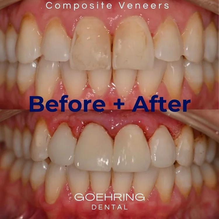 Porcelain Veneers &mdash; Goehring Dental Group, Implants. Cosmetic. General Dentistry