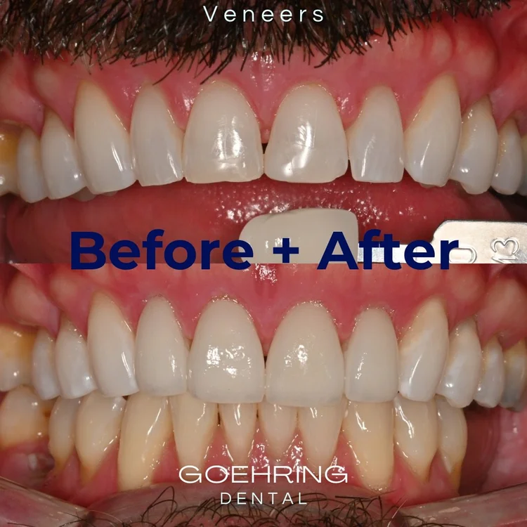 Porcelain Veneers &mdash; Goehring Dental Group, Implants. Cosmetic. General Dentistry
