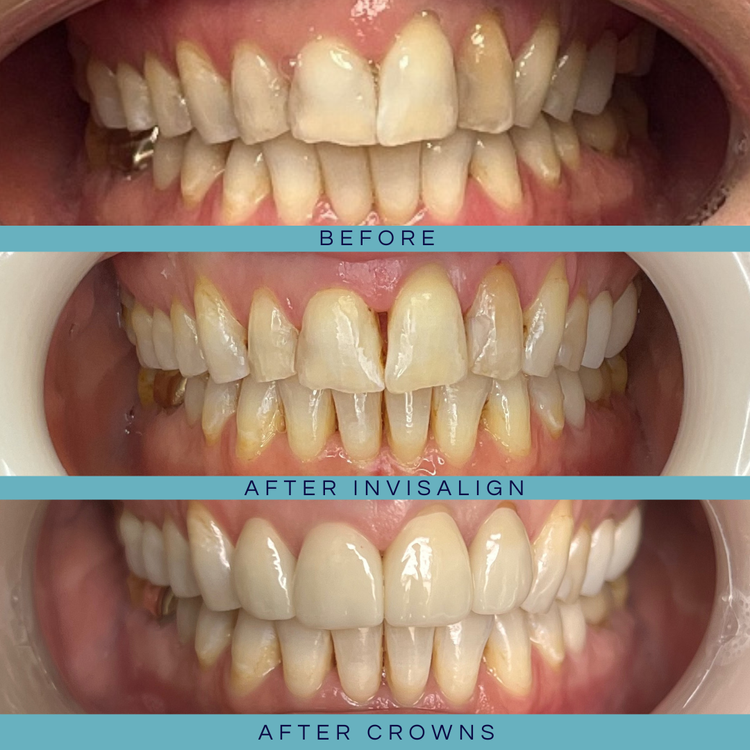 Invisalign / Orthodontics &mdash; Goehring Dental Group, Implants. Cosmetic. General Dentistry
