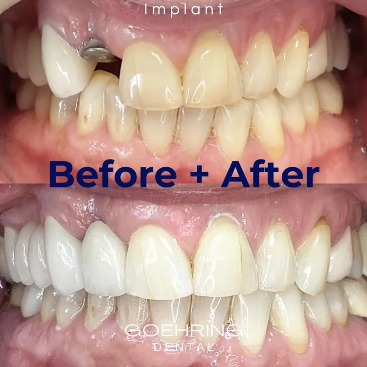 Dental Implants &mdash; Goehring Dental Group, Implants. Cosmetic. General Dentistry