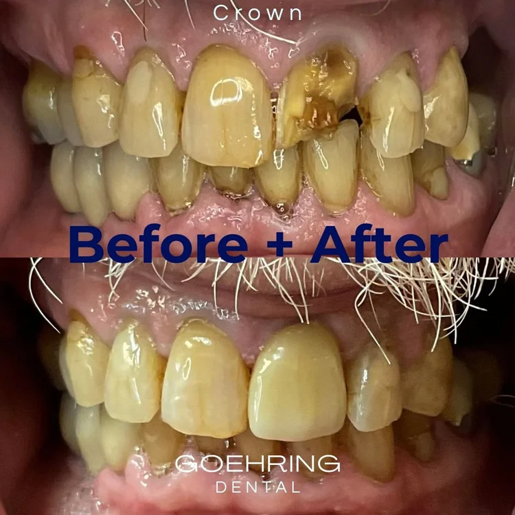 Crowns & Bridges &mdash; Goehring Dental Group, Implants. Cosmetic. General Dentistry