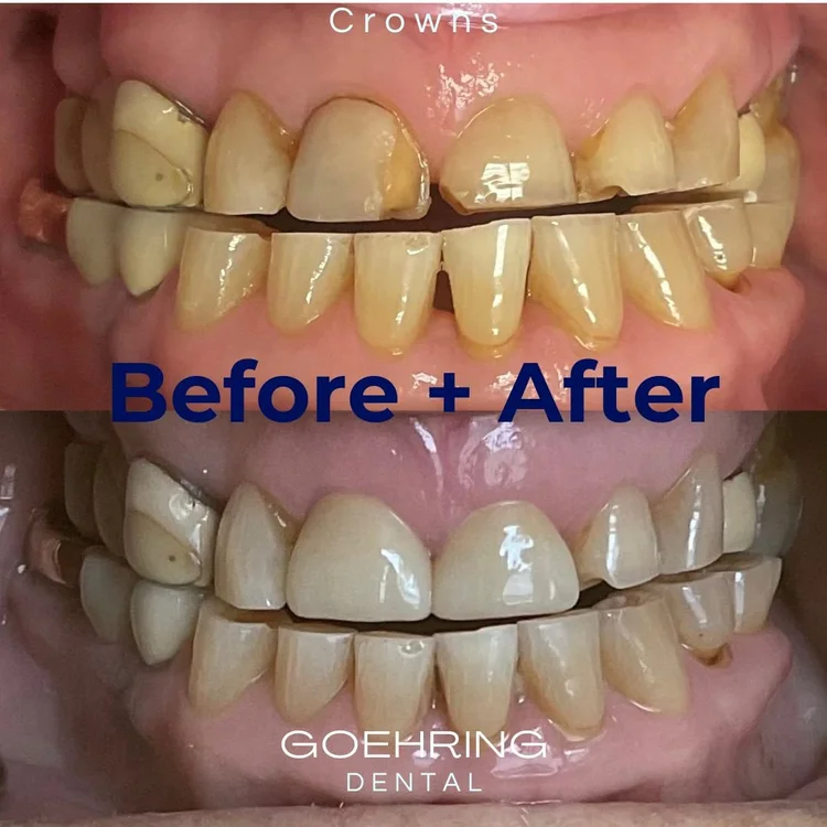 Crowns & Bridges &mdash; Goehring Dental Group, Implants. Cosmetic. General Dentistry