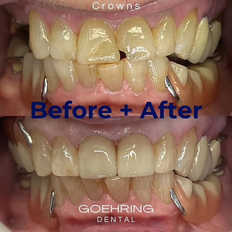 Crowns & Bridges &mdash; Goehring Dental Group, Implants. Cosmetic. General Dentistry