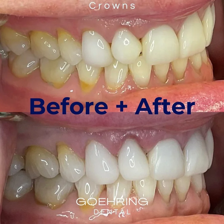 Crowns & Bridges &mdash; Goehring Dental Group, Implants. Cosmetic. General Dentistry