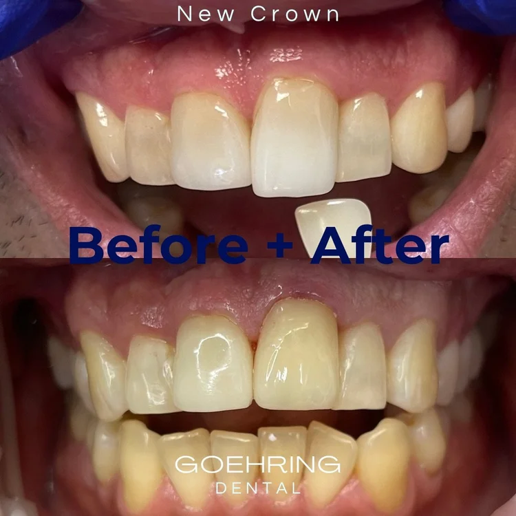 Crowns & Bridges &mdash; Goehring Dental Group, Implants. Cosmetic. General Dentistry