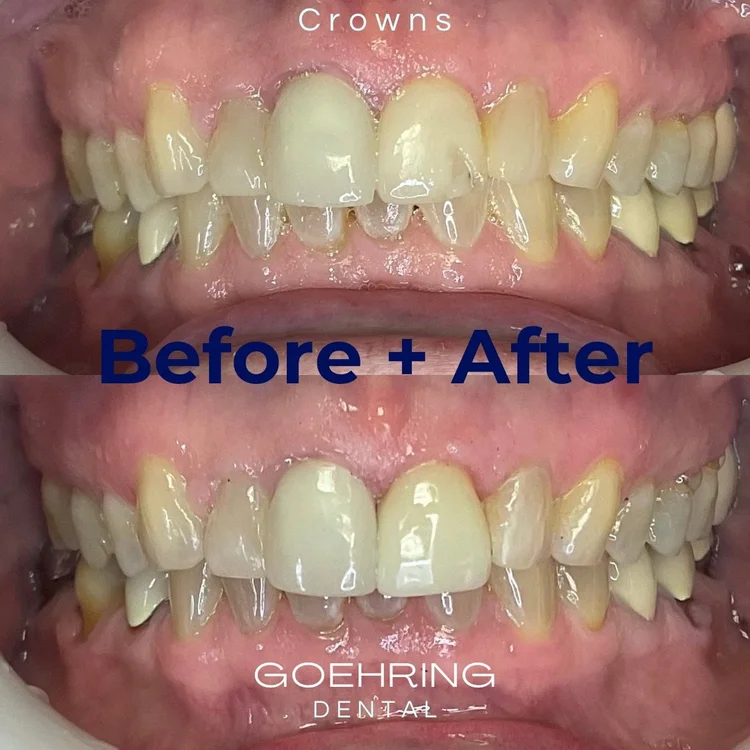 Crowns & Bridges &mdash; Goehring Dental Group, Implants. Cosmetic. General Dentistry