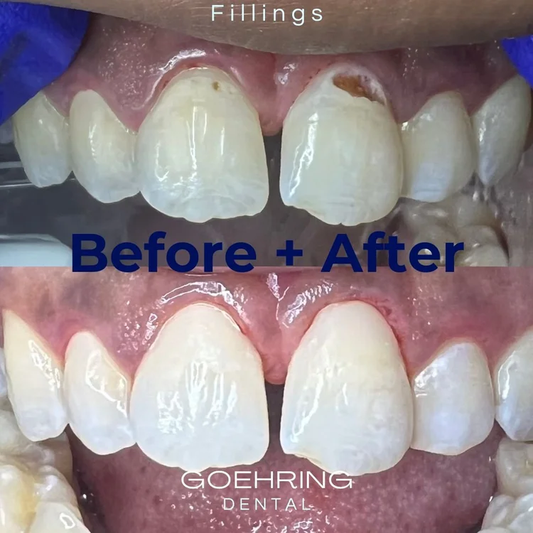 Full Mouth Restoration &mdash; Goehring Dental Group, Implants. Cosmetic. General Dentistry