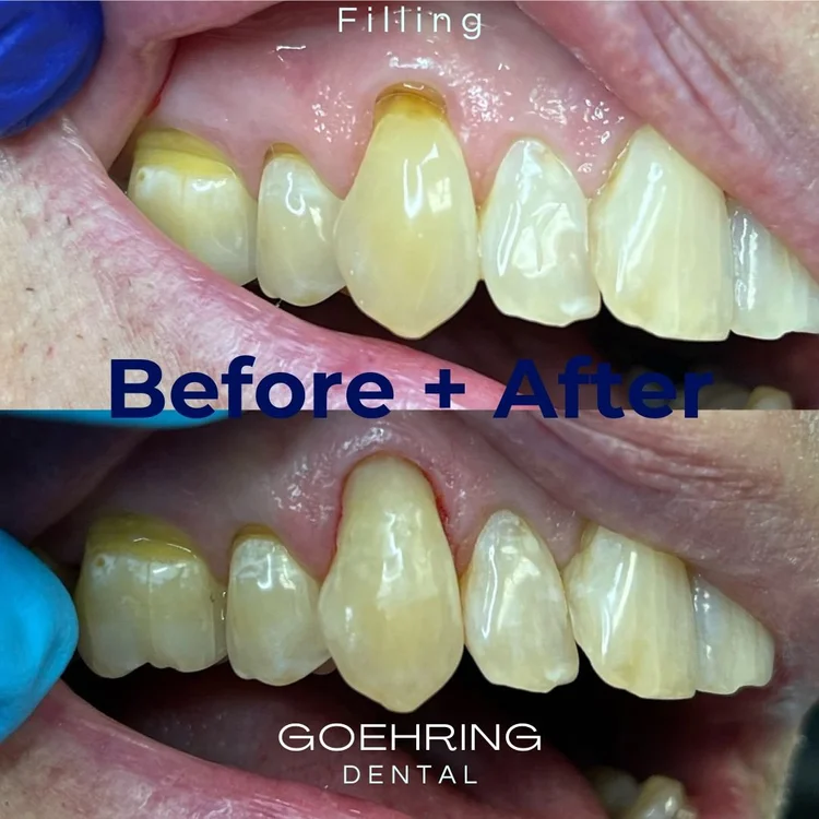 Full Mouth Restoration &mdash; Goehring Dental Group, Implants. Cosmetic. General Dentistry