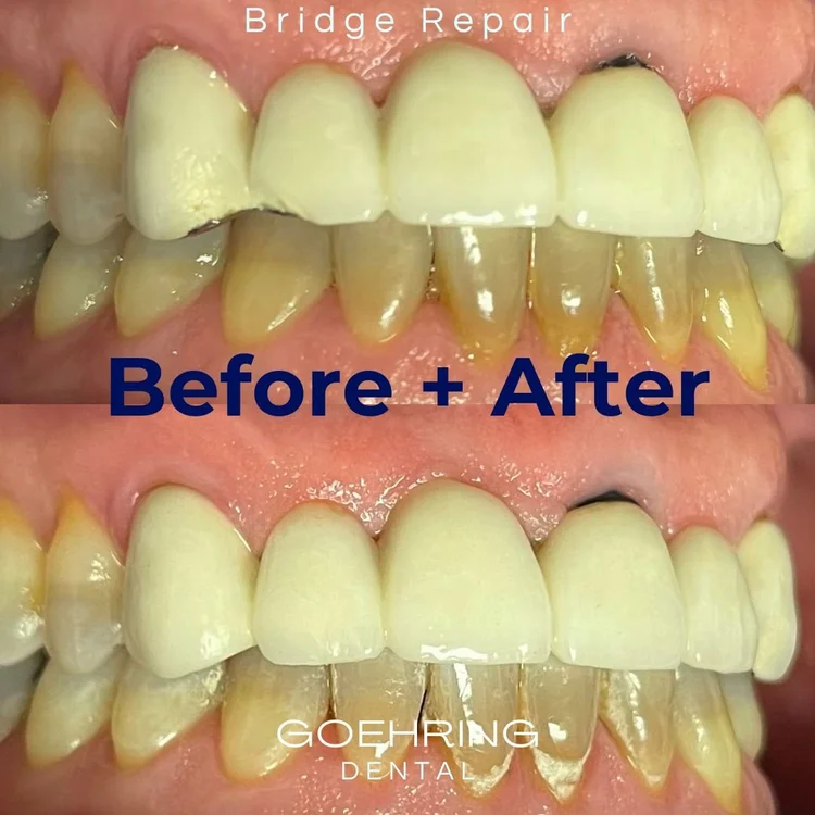 Crowns & Bridges &mdash; Goehring Dental Group, Implants. Cosmetic. General Dentistry