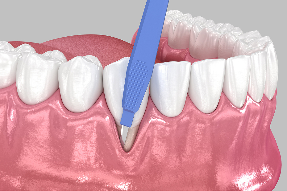 Periodontal treatment at Goehring Dental Group, Implants. Cosmetic. General Dentistry