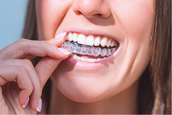 Invisalign® Promotion