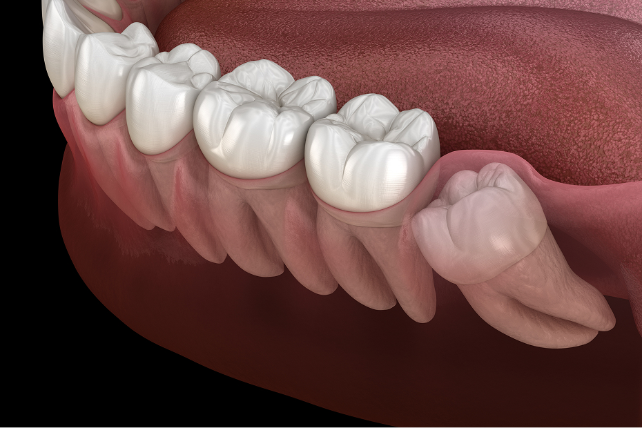 Wisdom teeth removal at Goehring Dental Group, Implants. Cosmetic. General Dentistry